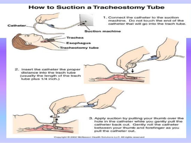 Millard recommend Teen pain tube